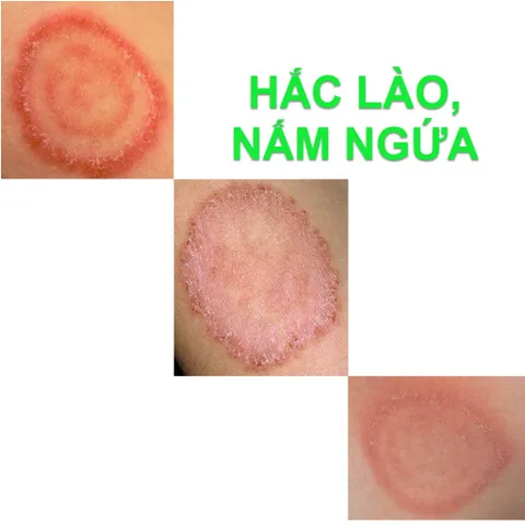 Kem bôi Hết Hẳn Nấm ngứa, Nấm hình tròn, Nấm đồng xu, Hắc lào Háng, Bụng, Đùi, Mông (Cực hiệu quả)_ loại 5g AT