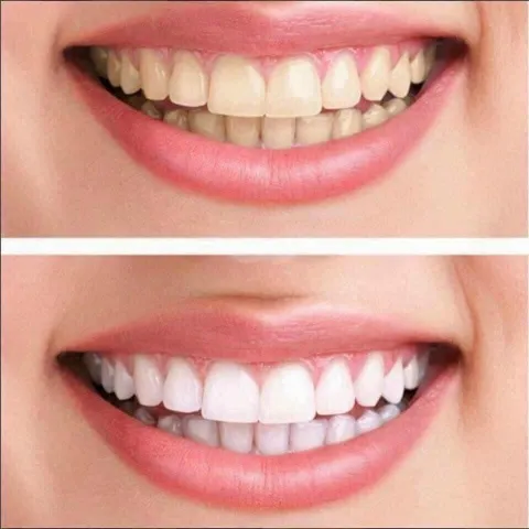 Lốc 5 Kem đánh răng Colgate Total Advanced Whitening của Mỹ
