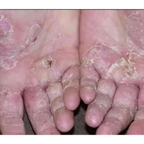 (xanh lá) - Kem bôi da thảo dược – Dưỡng ẩm, mềm da, giảm khô nứt tay chân, các vấn dề về da liễu