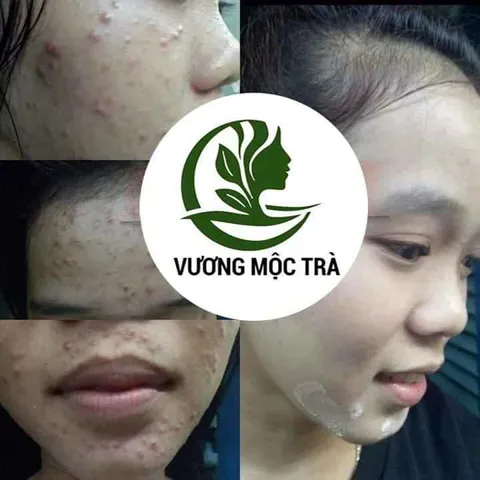 Serum tái tạo da CAO CẤP VƯƠNG MỘC TRÀ chai 30ml chuyên mụn, nám, tàn nhang, sẹo nhanh bong cực hiệu quả