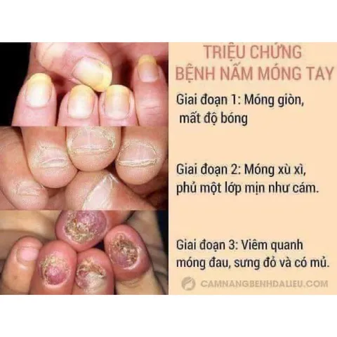 Dung dịch loại bỏ nấm móng Varisi hỗ trợ trị nấm móng nhanh chóng chuyên dụng ngành nail