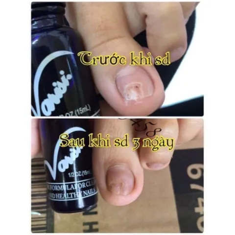 Dung dịch loại bỏ nấm móng Varisi hỗ trợ trị nấm móng nhanh chóng chuyên dụng ngành nail