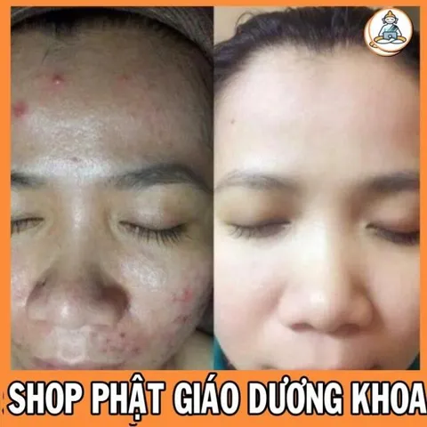 10Ml Cao lá nam sạch mụn, mờ thâm, dưỡng trắng da  DƯƠNG KHOA SHOP DƯƠNG KHOA SHOP