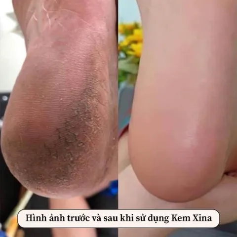 Kem mềm da vòi Sina giúp mềm da nhặt da, chà gót chân Nail & Spa chuyên dụng hàng chuẩn