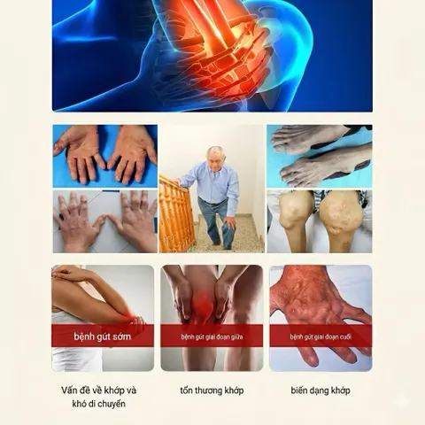 Kem Xoa Bóp Bôi Ngoài Da Baian Shi Tongfengao Giúp Giảm Đau Độ Gút Và Làm Dịu Cảm Giác Sưng Đỏ