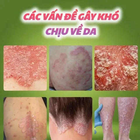 Kem Bôi Da Liễu Heyoul Hàn Quốc, Hỗ Trợ Giảm Ngứa Da Á Sừng Tổ Đỉa, Làm Dịu Da Nhạy Cảm 20g