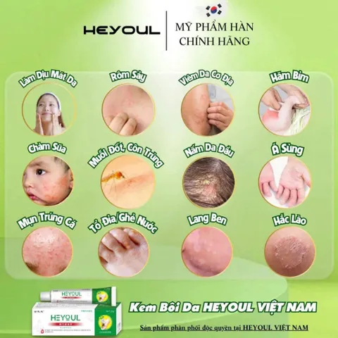 Kem Bôi Da Liễu Heyoul Hàn Quốc, Hỗ Trợ Giảm Ngứa Da Á Sừng Tổ Đỉa, Làm Dịu Da Nhạy Cảm 20g