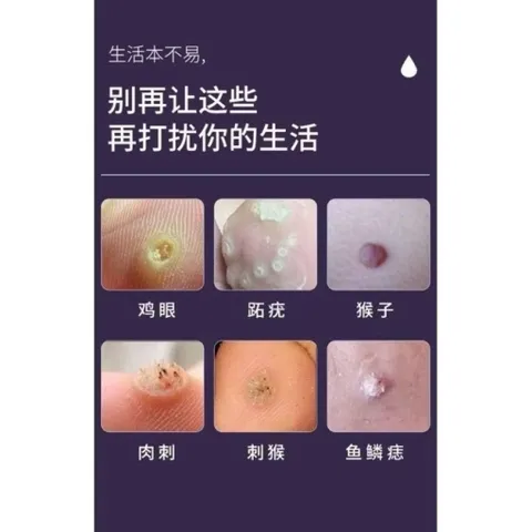 (Nhật Bản) Kem loại bỏ mụn thịt trên cổ, da thừa, mụn cóc dạng sợi, mụn nhỏ ở vùng nách, dưỡng sáng