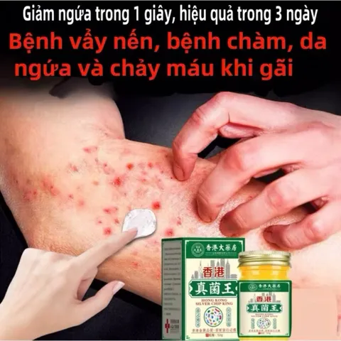 Kem bôi vẩy nến, viêm da kháng khuẩn đánh baynấm da, chống ngứa viêm da, hắc lào,lang ben, mề đay, á sừng