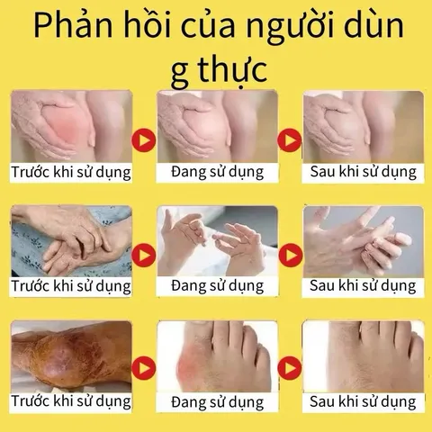 Kem Nọc Ong 20g Cao Cấp, Gel Bôi Xương Khớp Nọc Ong Giảm Đau Khớp Viêm Khớp Chính Hãng