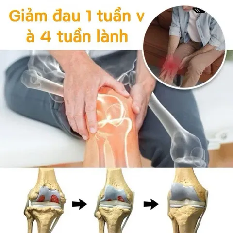 Kem Nọc Ong 20g Cao Cấp, Gel Bôi Xương Khớp Nọc Ong Giảm Đau Khớp Viêm Khớp Chính Hãng