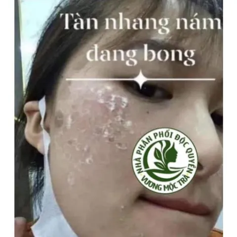 Chấm nám tàn nhang sẹo rỗ chấm là da đẹp lắp đầy sẹo rỗ VƯƠNG MỘC TRÀ - sản phẩm chuyên dùng trong spa