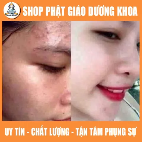 20ML CAO MỤN sạch mụn ẩn,mụn viêm, sáng da, mụn lâu năm 890818