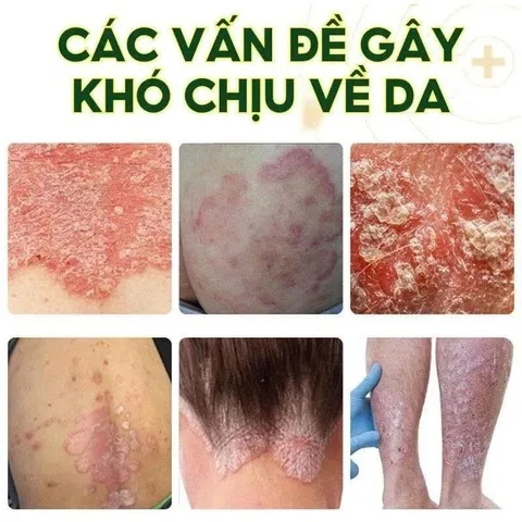 2 TUÝP TẶNG 1 Kem Bôi Nấm Ngứa Viêm Da Cơ Địa NHẬT BẢN Hắc Lào, Tổ Đỉa, Vẩy Nến, Á Sừng, Lang Ben Hiệu Quả