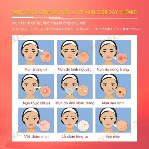 Kem Hỗ Trợ  Mụn Viêm, Mụn Đầu Đen, Mụn Đầu Trắng, Mụn Tuổi Dậy Thì, Mờ Thâm Mụn