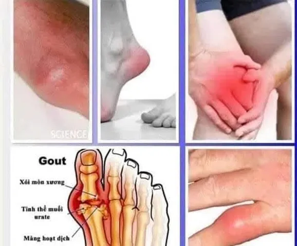 Hộp gout, gút 100 viên Hàn Quốc
