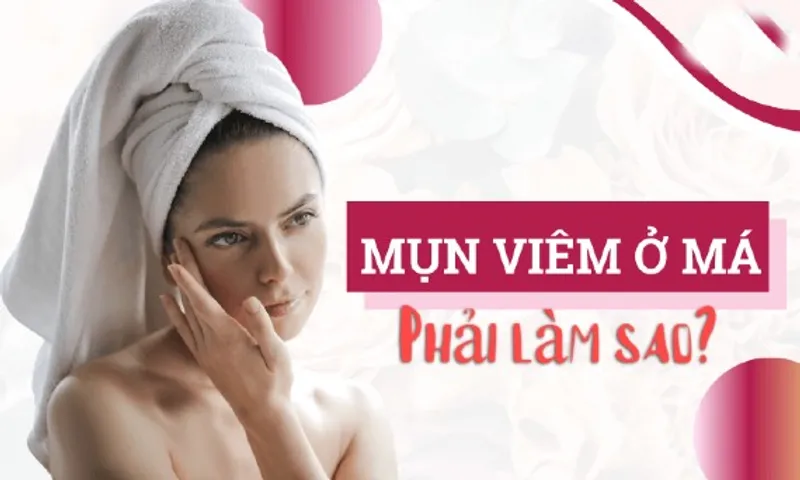 Top 11 cách trị mụn viêm đỏ không nhân tại nhà hiệu quả