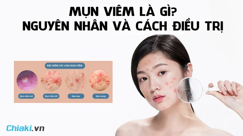Mụn viêm là gì? Nguyên Nhân và cách điều trị mụn viêm đỏ hiệu quả 