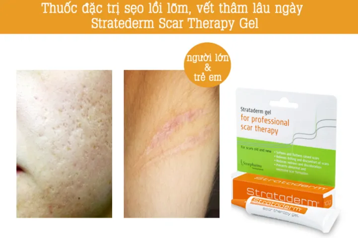 Kem Hỗ Trợ Cải Thiện Sẹo Lồi Strataderm Gel Thụy Sĩ - Hiệu Quả Cho Sẹo Lâu Năm Cho Người Lớn Và Trẻ Em
