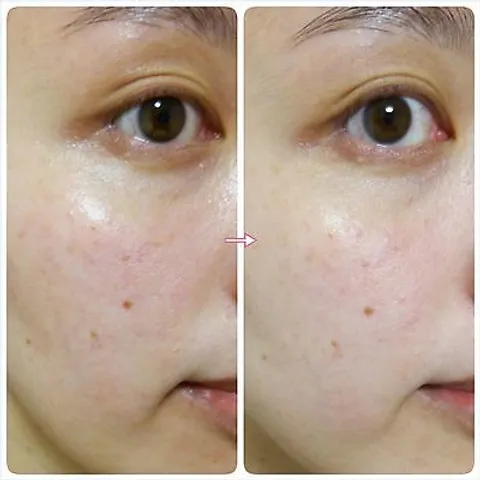 Serum Fracora Placenta Extract 30ml - Tinh Chất Nhau Thai Cừu Giúp Làm Sáng Da, Se Khít Lỗ Chân Lông, Cải Thiện Nếp Nhăn