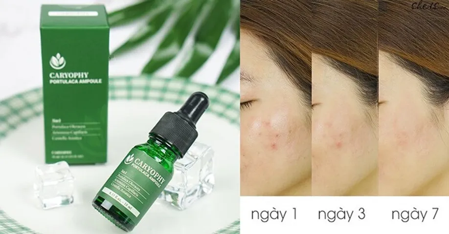 Serum Giảm Mụn và Thâm Caryophy Portulaca Ampoule 10ml - Sản Phẩm Chăm Sóc Da Từ Thiên Nhiên, Hiệu Quả Tức Thì