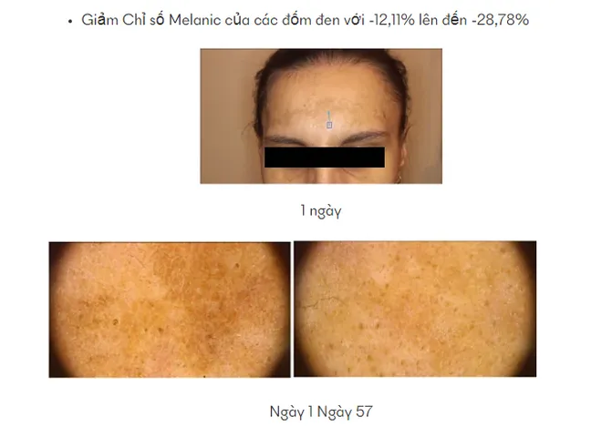 Kem Nám Ivawhite Whitening Cream - Hỗ Trợ Trắng Da, Giảm Nám, Tàn Nhang, Chất Lượng Cao, Dành Cho Da Nhạy Cảm 50ml