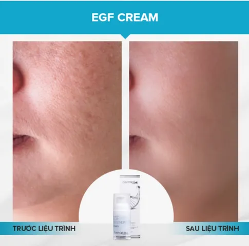 Kem tái tạo và làm mờ sẹo Dermica EGF 30ml - Hỗ trợ phục hồi da, giảm sẹo rỗ, công nghệ sinh học tiên tiến