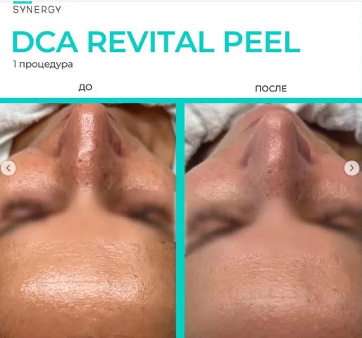 Tẩy Tế Bào Da Chết Skin Synergy DCA Revital Peel - Gel Peel Chống Oxy Hóa, Làm Sáng Da Khỏe Mạnh, Duy Trì Độ Ẩm Mượt