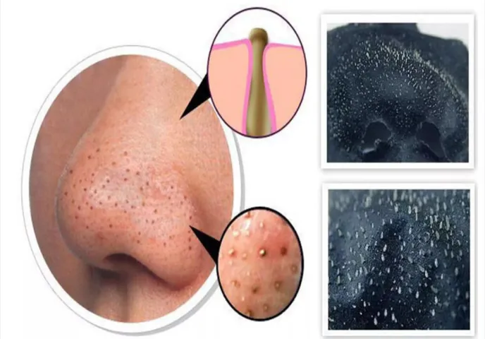 Gel lột mụn than tre hoạt tính, giúp se khít lỗ chân lông - Thái Lan