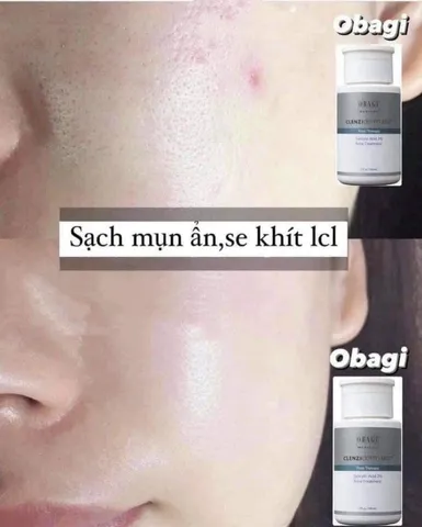 (Có tem) BHA 2% ngừa mụn, giảm dầu nhờn, thu nhỏ lỗ chân lông Obagi