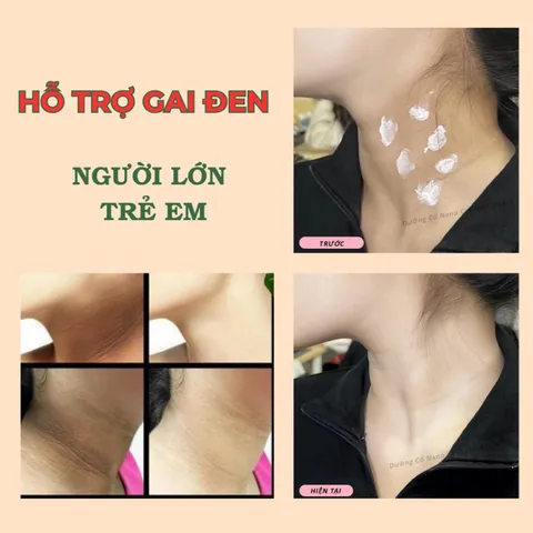 Kem Dưỡng Da Cổ Loka Nano Abera - Làm Trắng, Hỗ Trợ Gai Đen, Chống Nắng SPF 30+ cho Da Mịn Màng, Hấp Dẫn