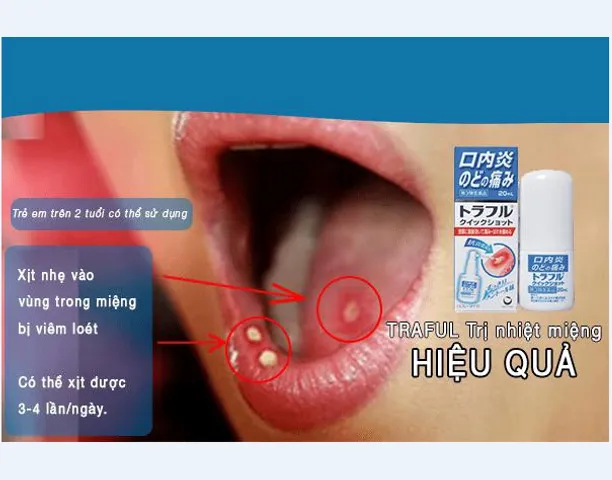 Xịt Giảm Đau Nhiệt Miệng Traful 20ml - Chăm Sóc Răng Miệng Nhật Bản, Hiệu Quả Giảm Đau Lở Miệng, Dễ Sử Dụng