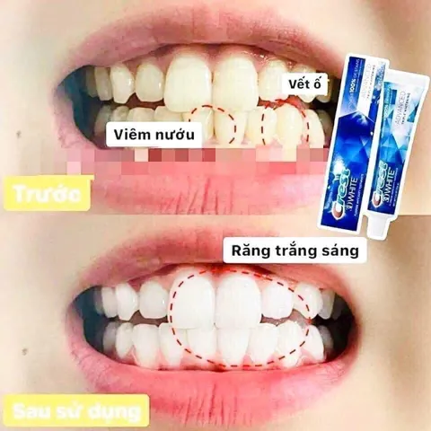 KĐR Crest 3D White Advanced Tripple Whitening Làm Trắng Răng Cấp Tốc lốc 5 tuýp