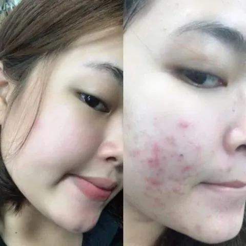 Dược mỹ phẩm sạch mụn Lion Pair Acne Cream W Nhật Bản 24g