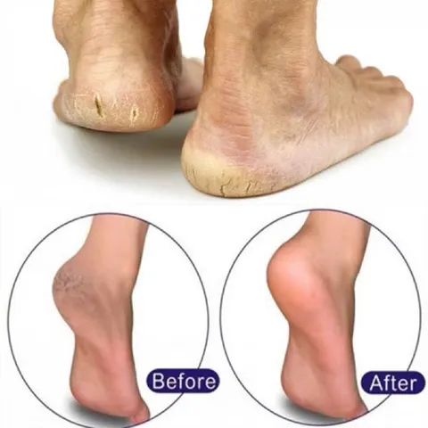 Kem Dưỡng Mềm Mịn, Chống Nứt Nẻ Gót Chân Fixderma Foot Cream 60g 215231
