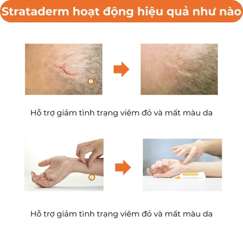 Kem Strataderm Thụy Sĩ - Gel Hỗ Trợ Cải Thiện Sẹo Lồi, Mờ Sẹo Lâu Năm, An Toàn Cho Cả Người Lớn Và Trẻ Em