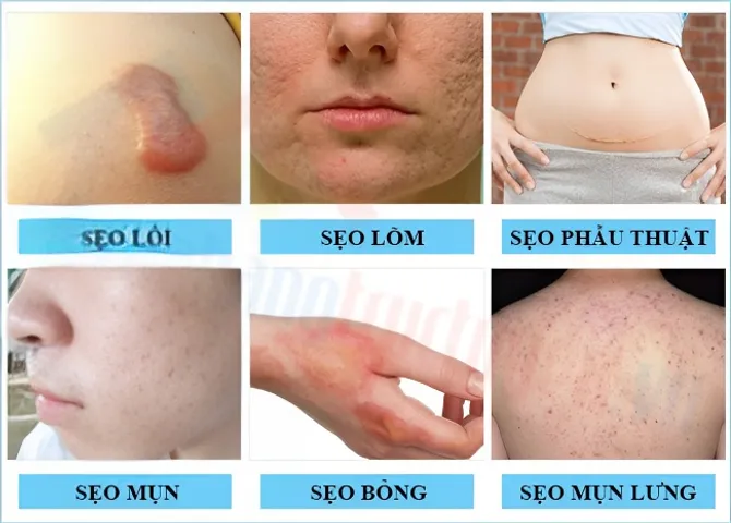 Kem giảm mờ sẹo Kobayashi Nhật Bản 15g - Giúp làm mờ vết sẹo hiệu quả, an toàn cho da, sản phẩm chăm sóc da chất lượng cao.