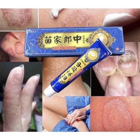 Kem bôi vảy nến, nấm ngứa, á sừng