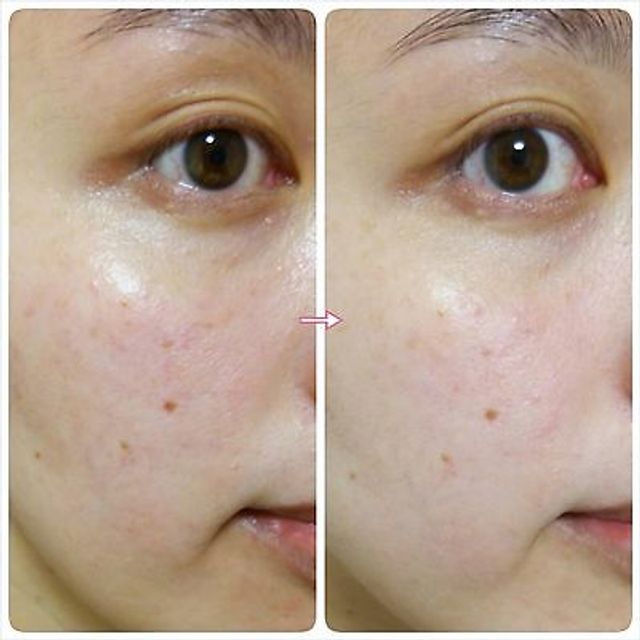 Tinh chất nhau thai Fracora Extract hồng gi&uacute;p cung cấp cho l&agrave;n da những dưỡng chất tối ưu