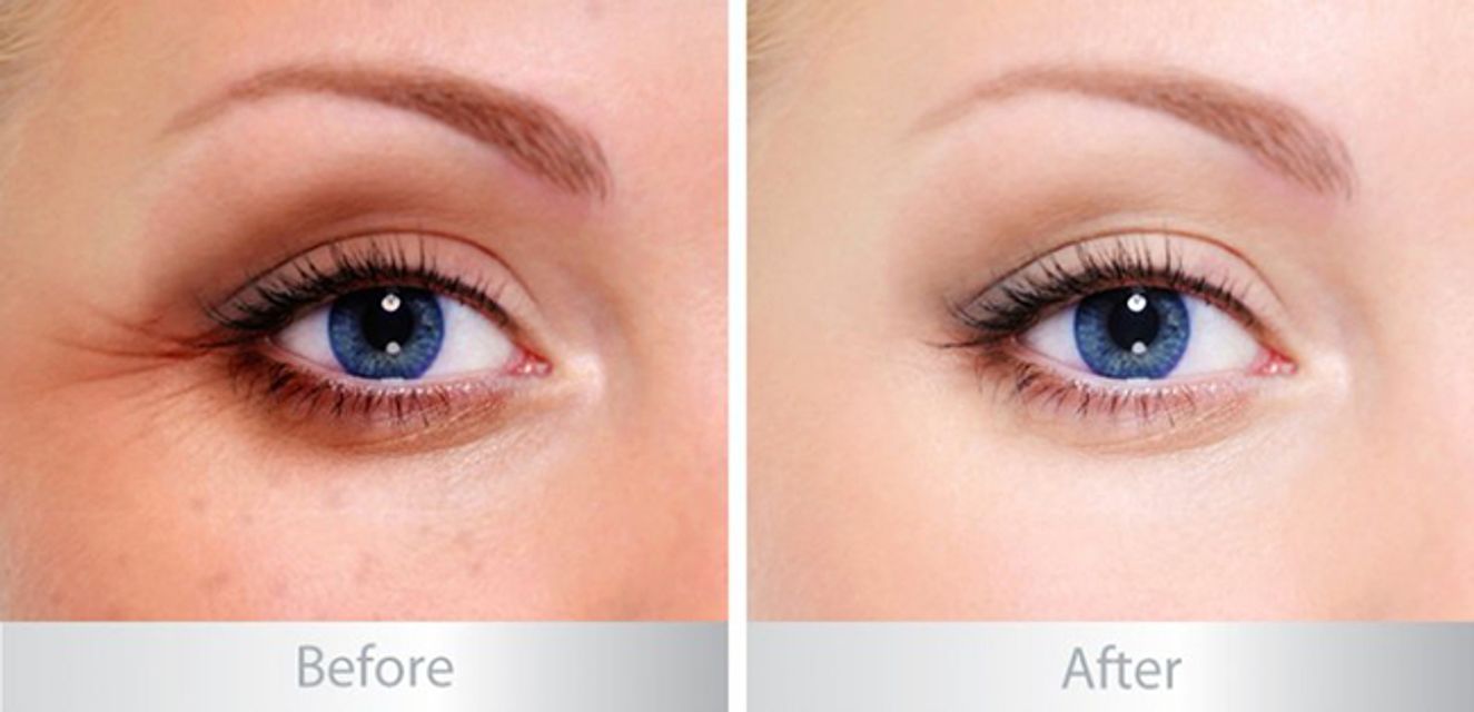 Lăn x&oacute;a nhăn v&ugrave;ng mắt Eveline Biohyaluron 4D ngay lập tức l&agrave;m m&aacute;t da, dưỡng ẩm s&acirc;u suốt 24 giờ, th&uacute;c đẩy lưu th&ocirc;ng mạch m&aacute;u