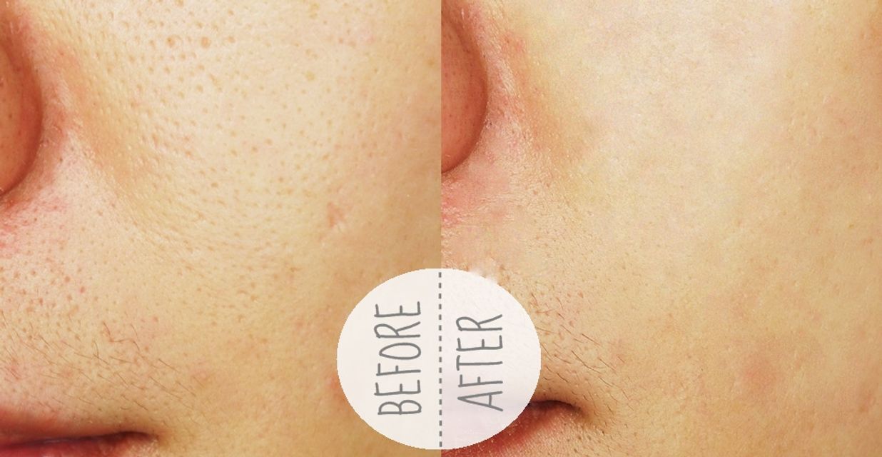 nước hoa hồng La Roche Posay Effaclar lotion astringente Micro Exfoliante gi&uacute;p thu nhỏ lỗ ch&acirc;n l&ocirc;ng