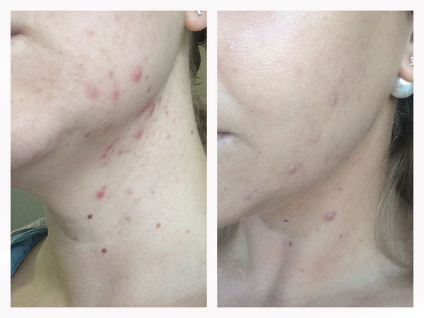  Bioderma Sebium Global gi&uacute;p điều tiết b&atilde; nhờn, giảm mụn hiệu quả