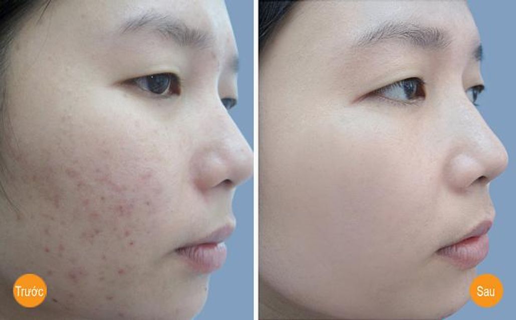 SVR Sebiaclear Cicapeel mang đến hiệu quả trị mụn nhanh ch&oacute;ng, hiệu quả