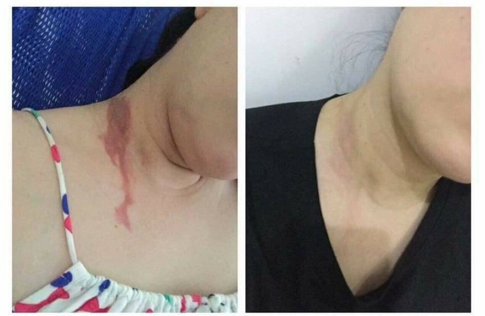 Kem chăm sóc sẹo Gentacin 10g của Nhật Bản ch&iacute;nh h&atilde;ng