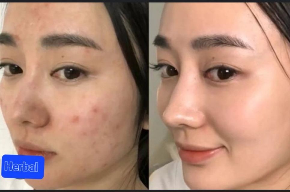 Kem Nghệ chấm Mụn, Làm Mờ Vết Thâm Herbal 3