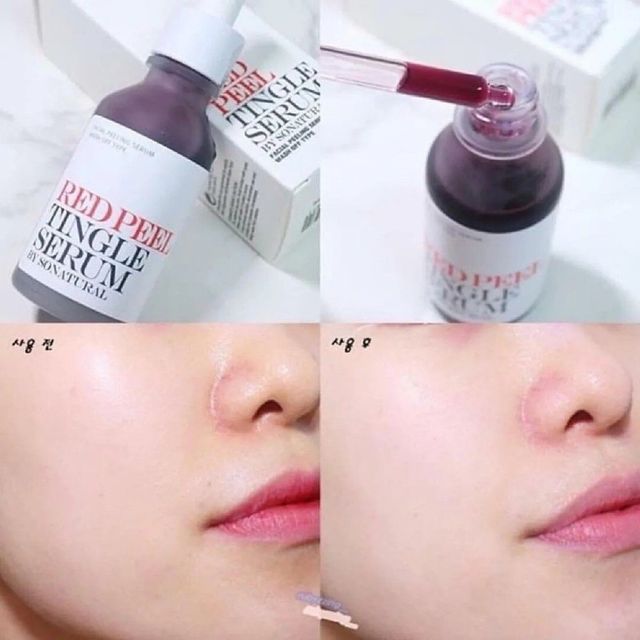 Tinh Chất Red Peel Da Sinh Học Tingle So Natural 10ml