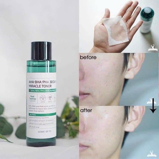 Nước hoa hồng hỗ trợ mụn Some By Me 30days Miracle toner