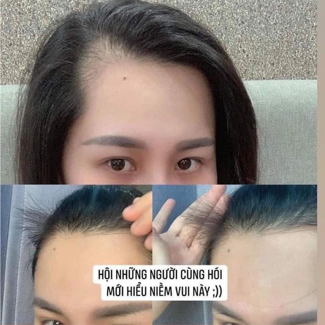 Xịt Mọc T&oacute;c Minoxidil Bailleul 2%, 5% Ph&aacute;p