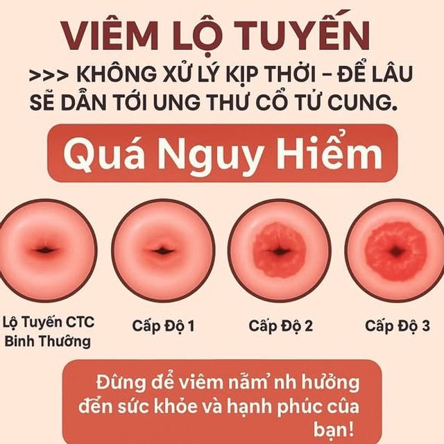 Vi&ecirc;n đặt phụ khoa Mycohydralin 500mg