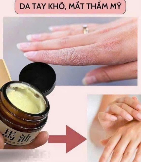 Kem b&ocirc;i nứt g&oacute;t ch&acirc;n đầu ngựa